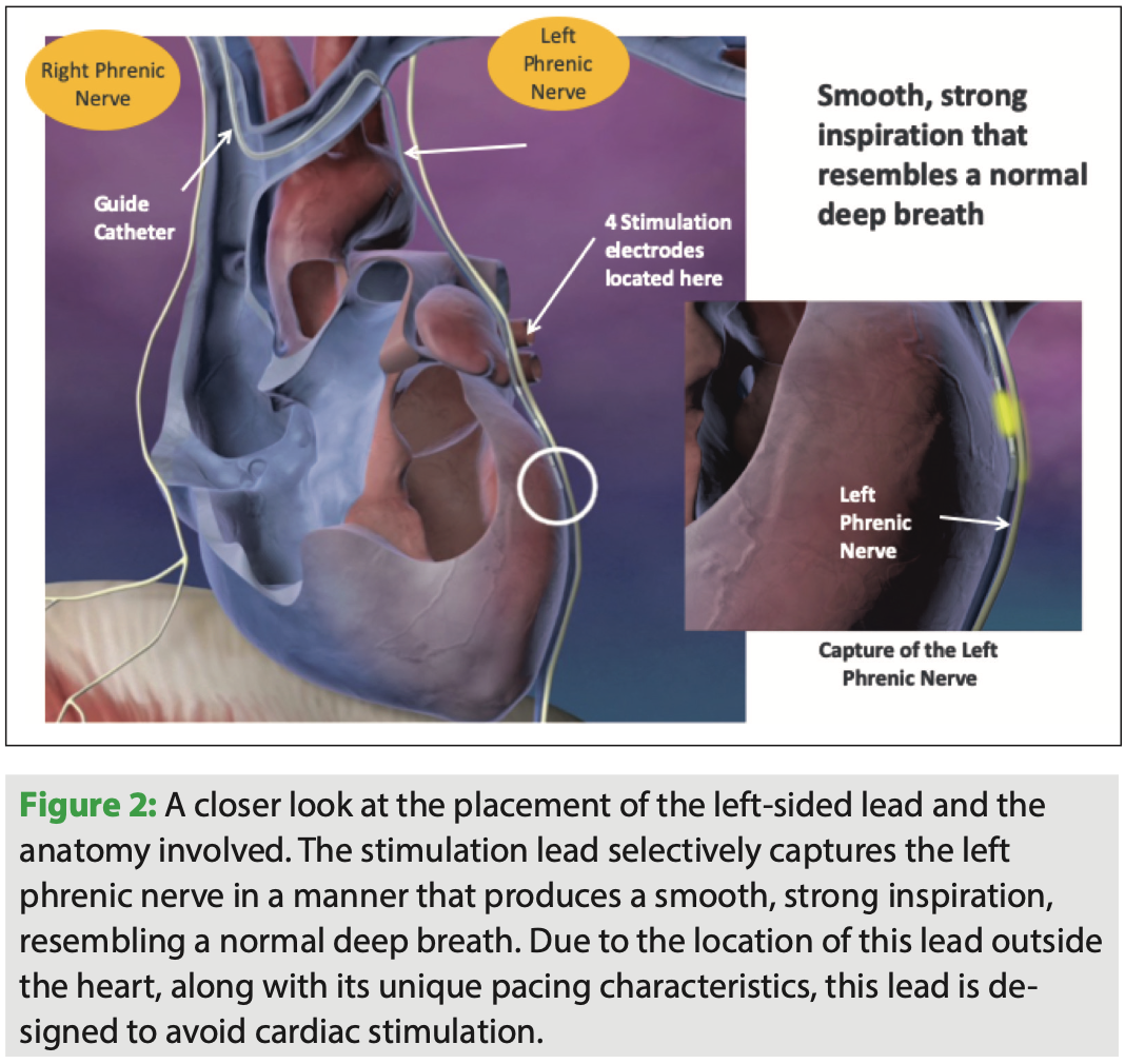 Phrenic Nerve Pacing: A Revolution in the Treatment of Central Sleep Apnea